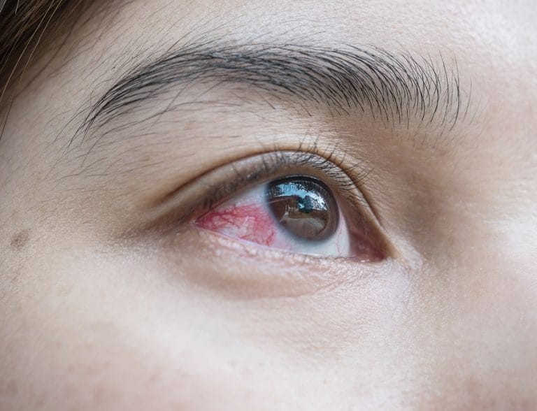 subconjunctival hemorrhage1.jpg