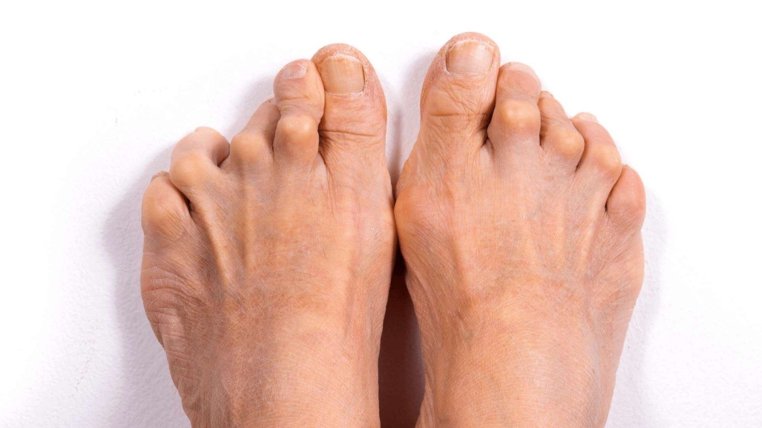 arthritis 3.jpg
