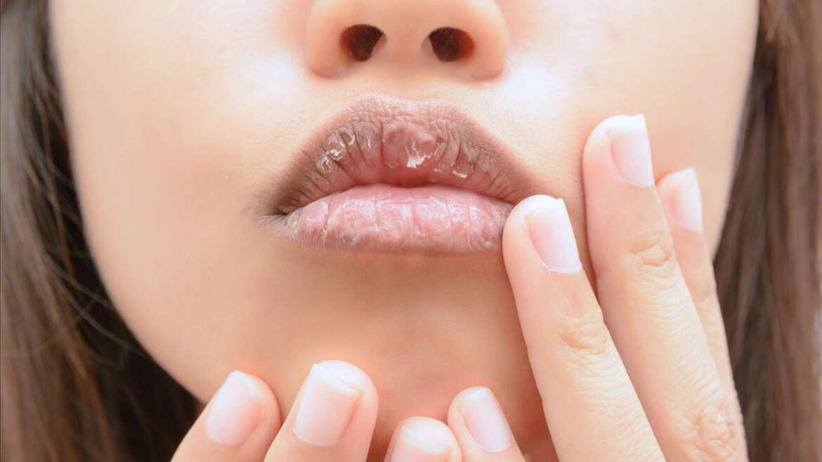 dry lips_2.jpg