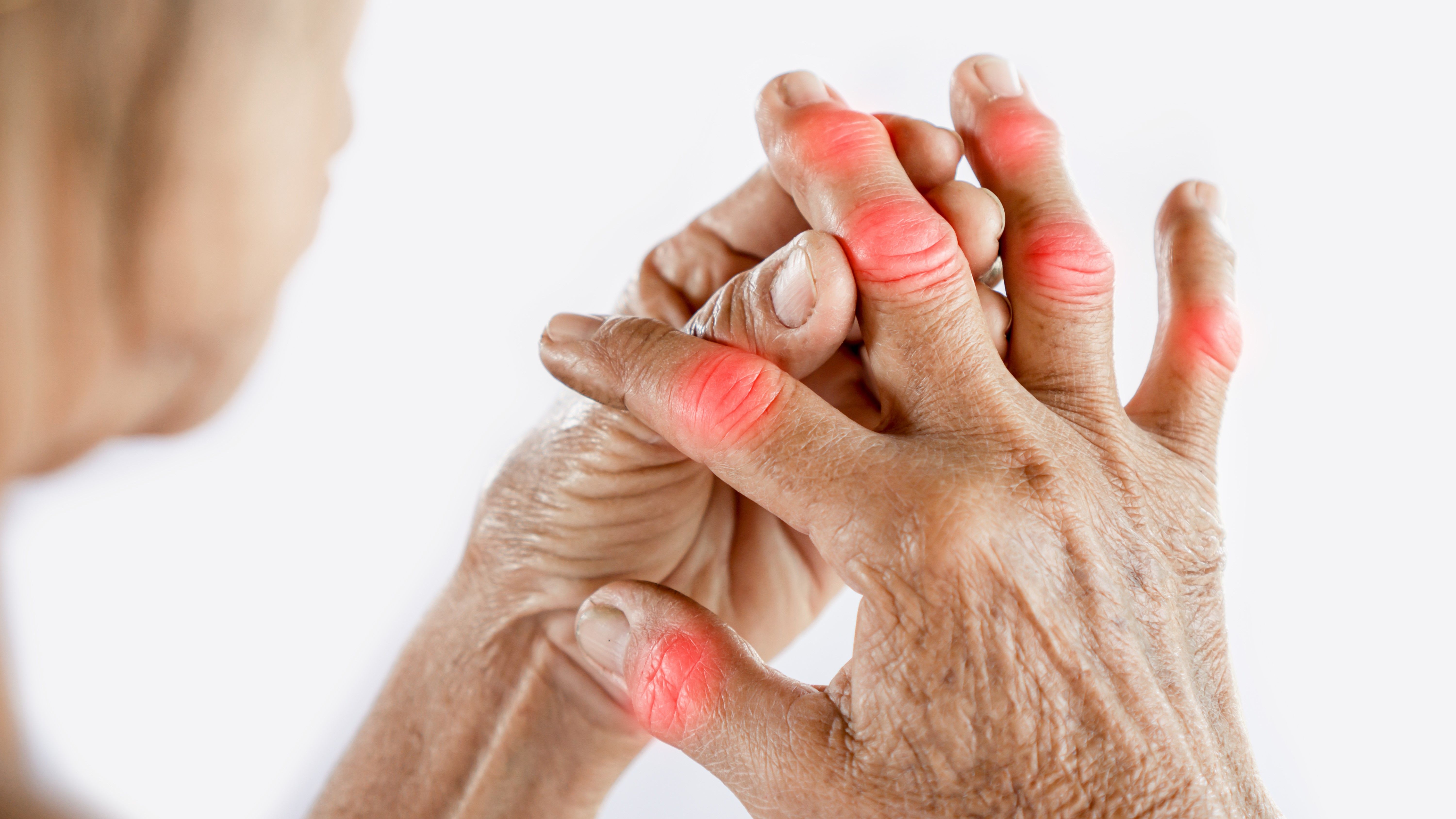 arthritis 1.jpg