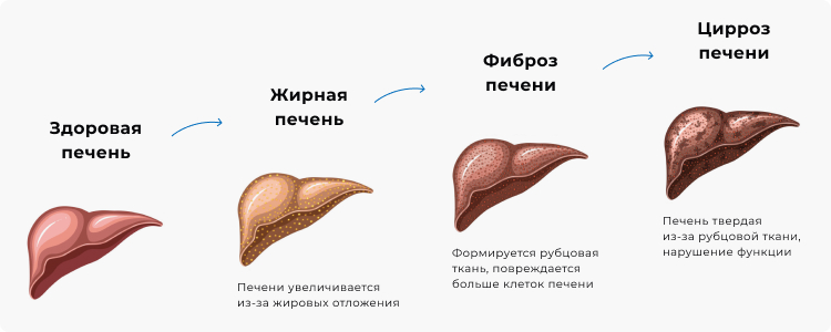 Чем опасна жировая печень. Жировой гепатоз. Советы гепатолога